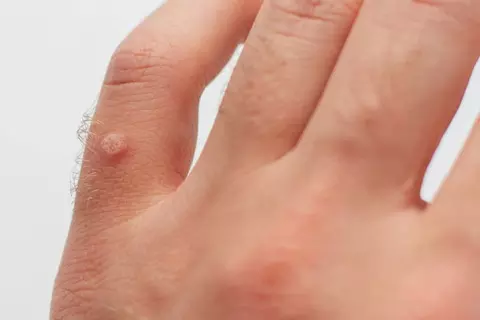 Warzen