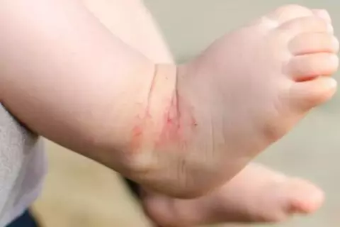 Neurodermitis